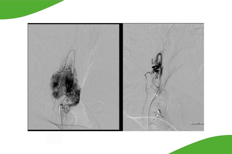 Grafik aus zwei Bildern: Praeoperative  Embolisation eines  Glomustumor an der  Carotisgabel. Vor der  Embolisation (links) ist ein  kräftiger Tumorblush  erkennbar, passend zu der  starken Blutversorgung  dieses Tumors. Nach der  Partikelembolisation  (rechts) ist der Tumor  ‘devaskularisiert‘. Das  Tumorbett ist  verschlossen. Am Folgetag  wurde der Tumor ohne   Blutung entfernt. 