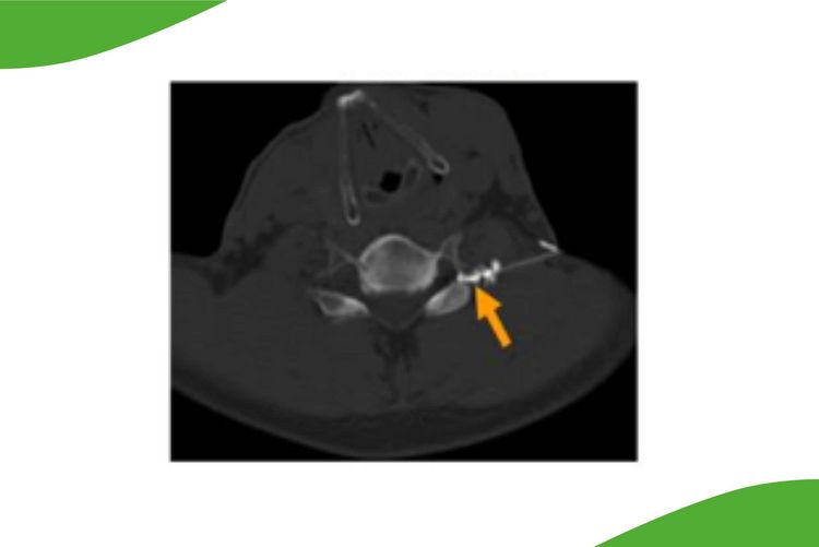 CT-Bild einer Infiltration cervical