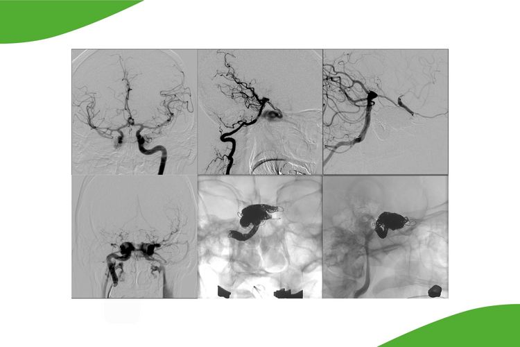 Grafik aus sechs Bilder: Interventionelle Behandlung einer  traumatischen Kurzschluss verbindung zwischen Hirnarterie  und Hirnvenensystem (Arteria  carotis -Sinus cavernosus -Fistel)  mittels Coiling