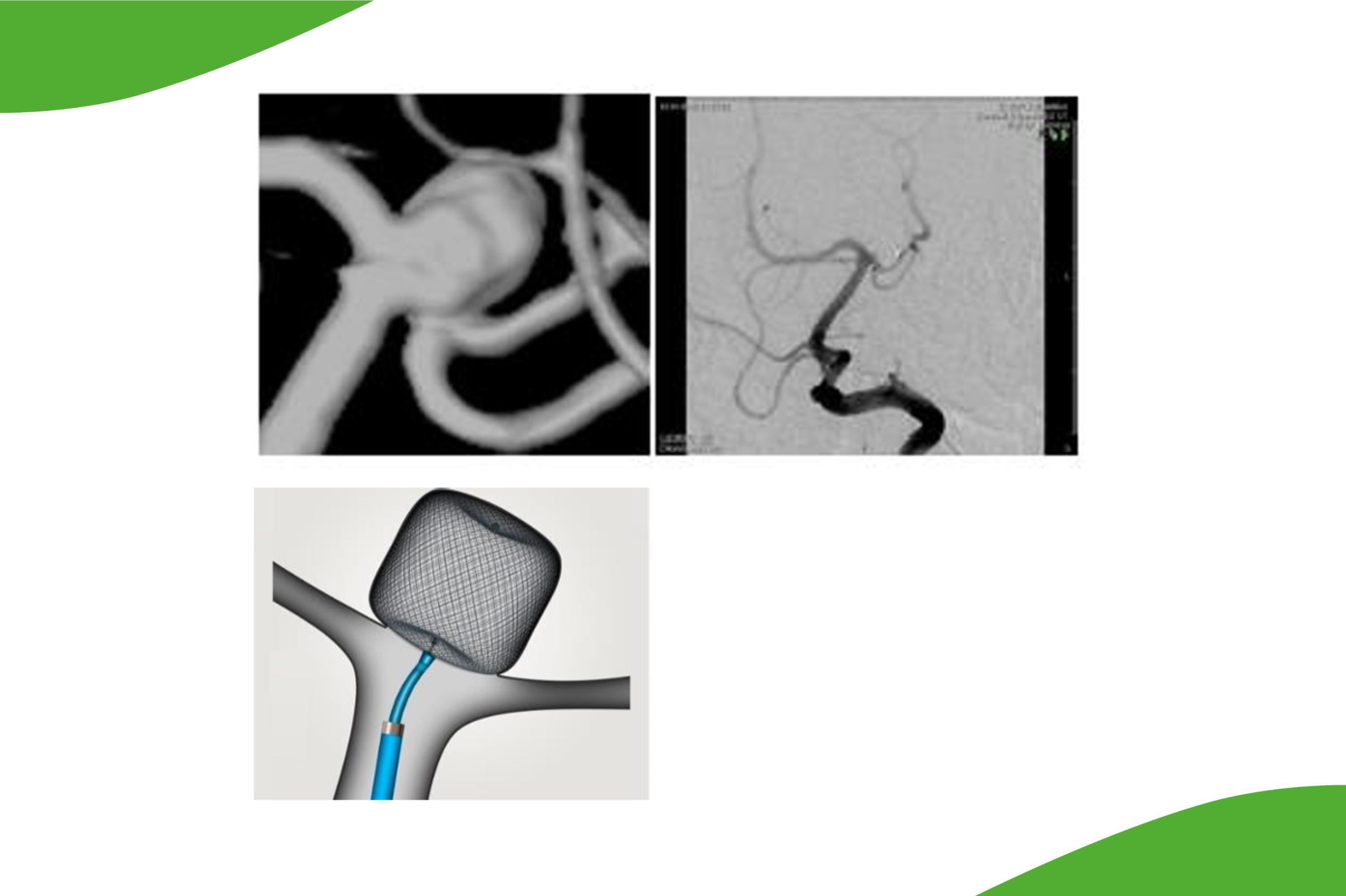 Darstellung eines Verschlusssystems für ein Hirnarterienaneurysma