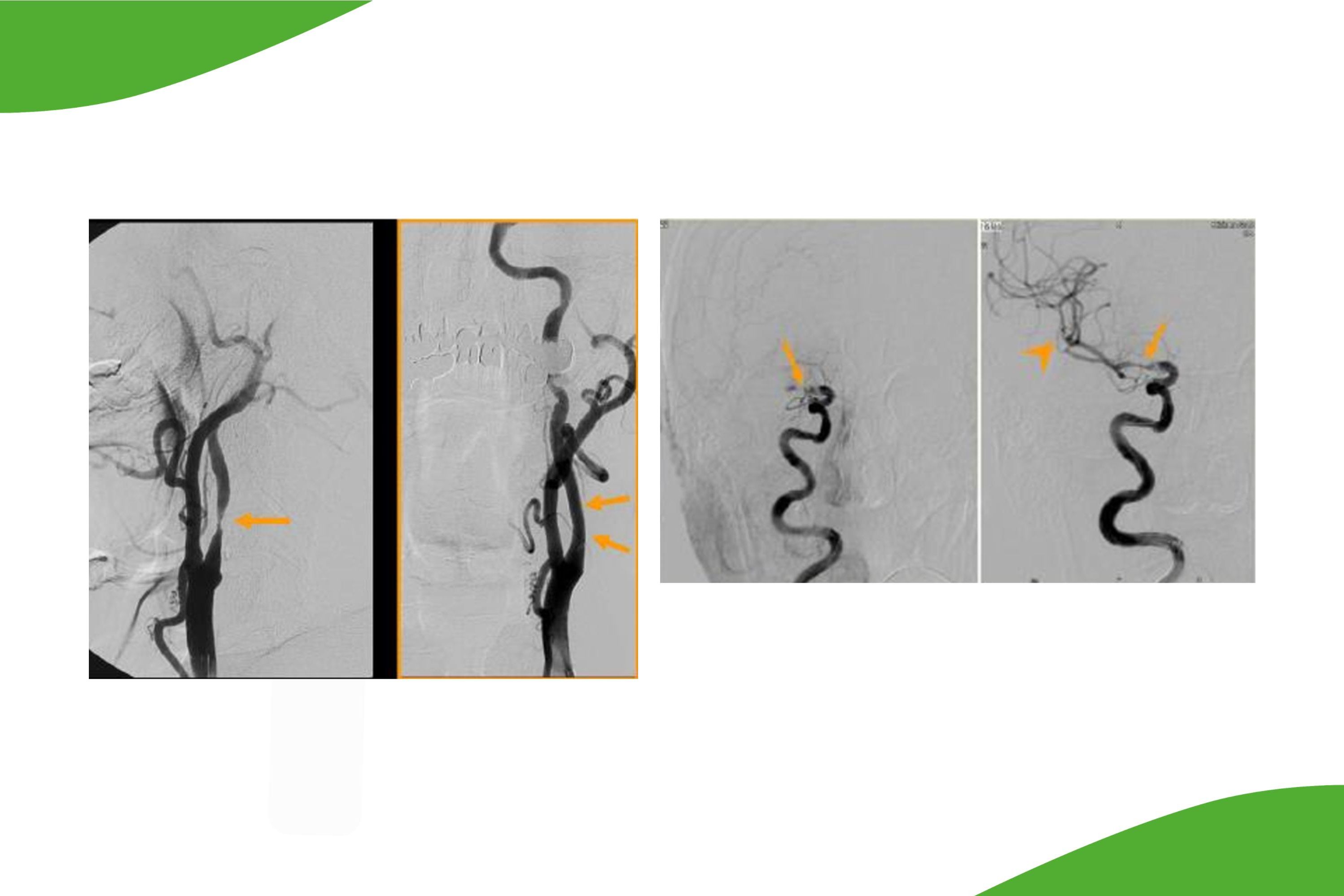 Vier Grafiken: . Wiedereröffnung von Hirnarterien und Erweiterung von extra- und auch  intracraniellen Gefäßen 