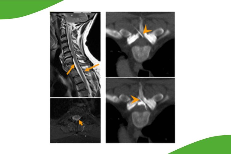 CT-Bild: CT-gesteuerte epidurale Eigenblutpatch-Applikation bei  Liquorverlustsyndrom 