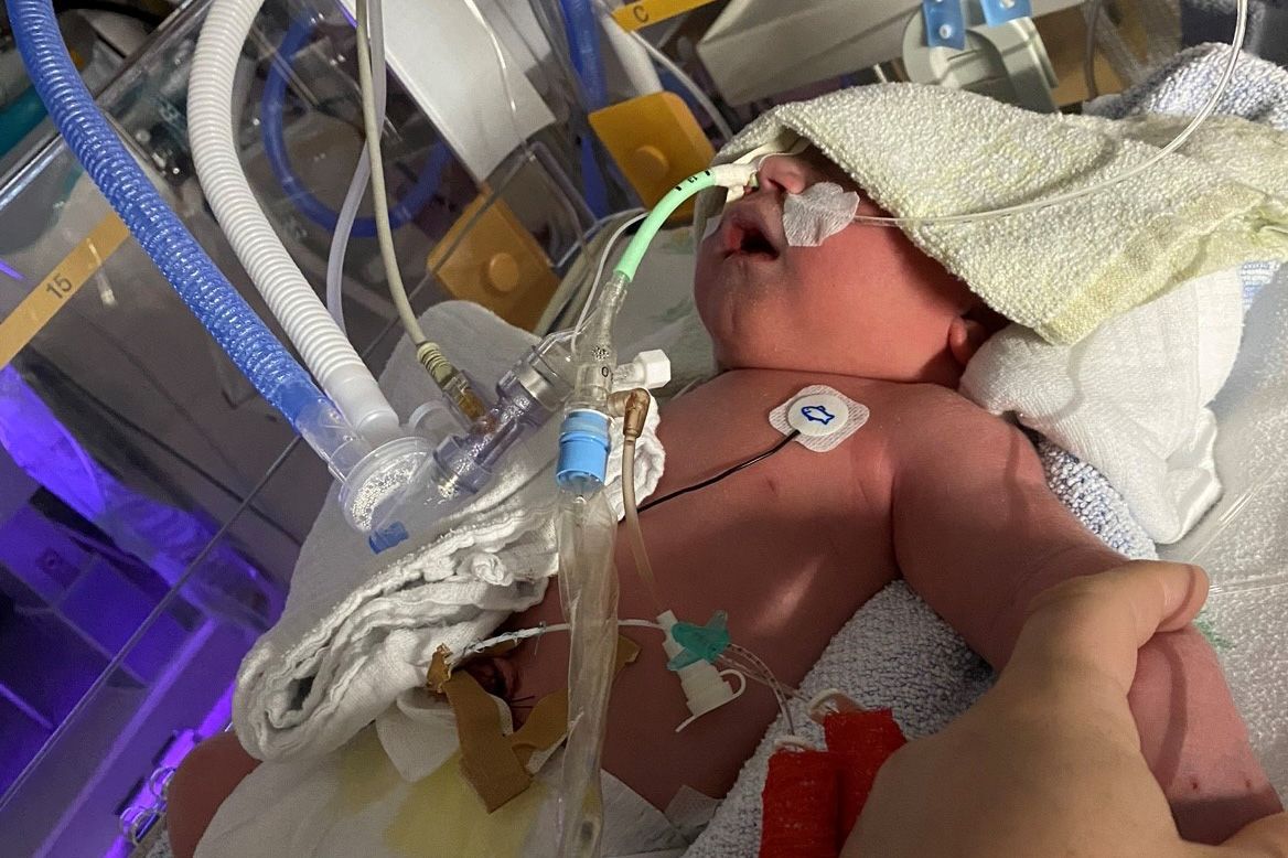 Neugeborenes Kind auf der Intensivstation mit Beatmungsschlauch.